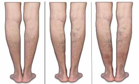 Stages of varicose veins