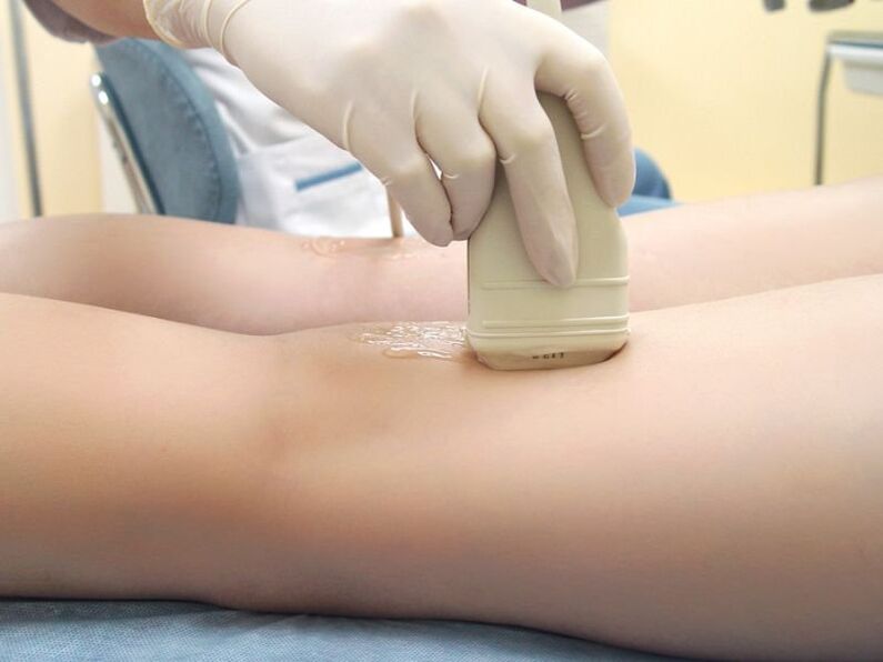 Varicose veins