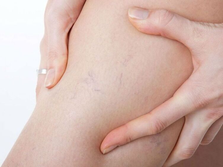 varicose veins