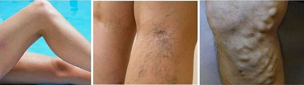 The appearance of varicose veins of the legs
