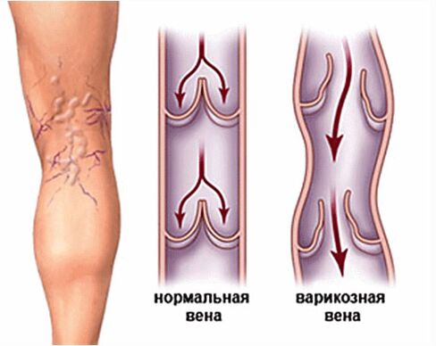 Different veins