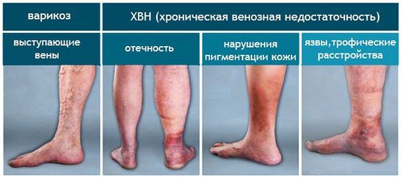 Stages of varicose veins