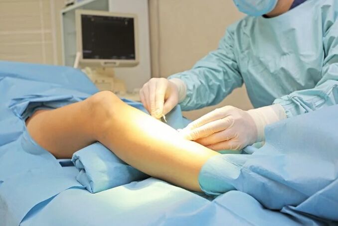 Work to remove veins on the feet