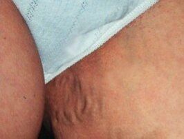 Varicose veins of the small pelvis